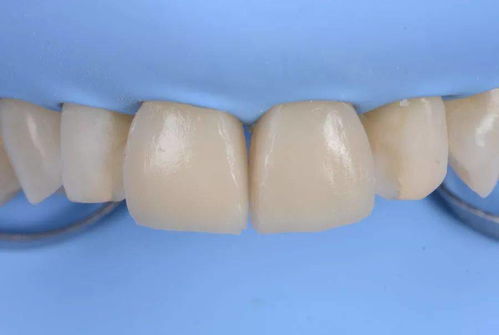门牙美学树脂修复病例分享